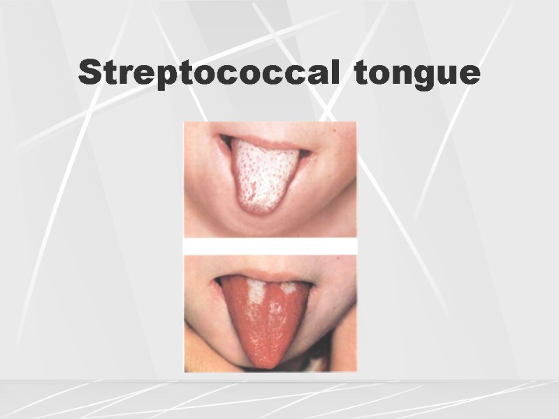 Streptococcal tongue